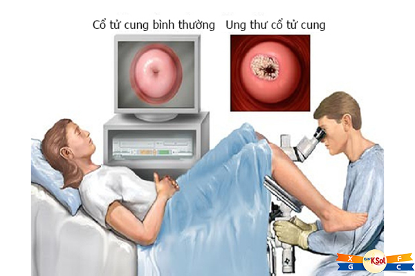 Phương pháp điều trị ung thư cổ tử cung