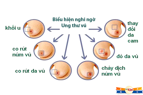 Nguyên nhân gây ung thư vú