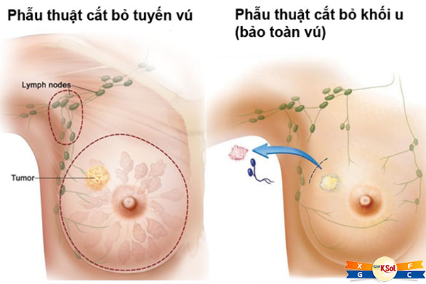 Chụp nhũ ảnh thường xuyên giúp phát hiện ung thư vú sớm.