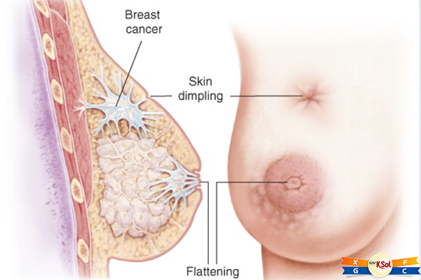 Vú bị sưng, đỏ, mẩn ngứa, sần sùi hay lồi lõm bất thường có thể là dấu hiệu cảnh báo ung thư vú.