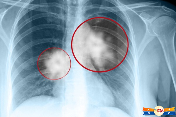 Điều trị ung thư phổi áp dụng nhiều nhất hiện nay