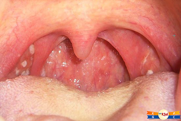 Triệu chứng bệnh ung thư vòm họng