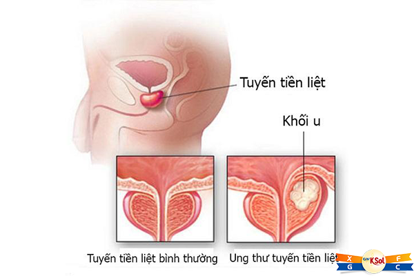Ung thư tuyến tiền liệt nguyên nhân do đâu ?