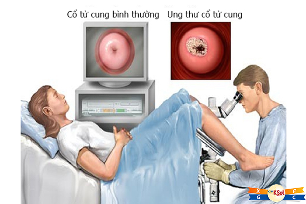 Phương pháp điều trị ung thư cổ tử cung qua từng giai đoạn