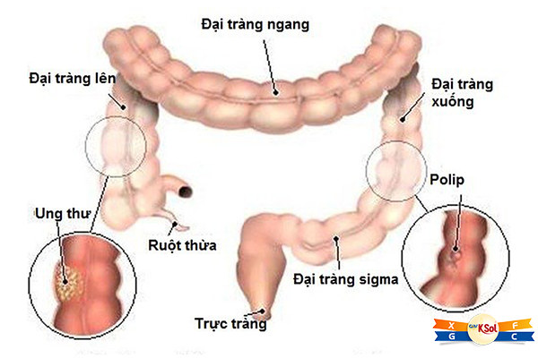 Ung thư đại – trực tràng là ung thư phát khởi nguyên thủy từ ruột già, là phần cuối cùng của ống tiêu hóa