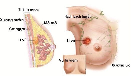 Khối u ở vú là dấu hiệu ung thư vú