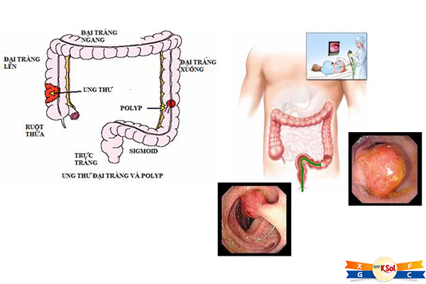 Triệu chứng của ung thư đại – trực tràng là gì?