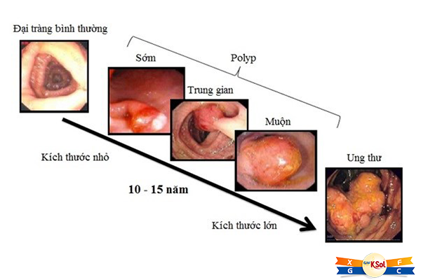 Ngăn ngừa ung thư đại trực tràng như thế nào?