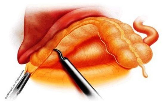 Phẫu thuật cắt đại tràng