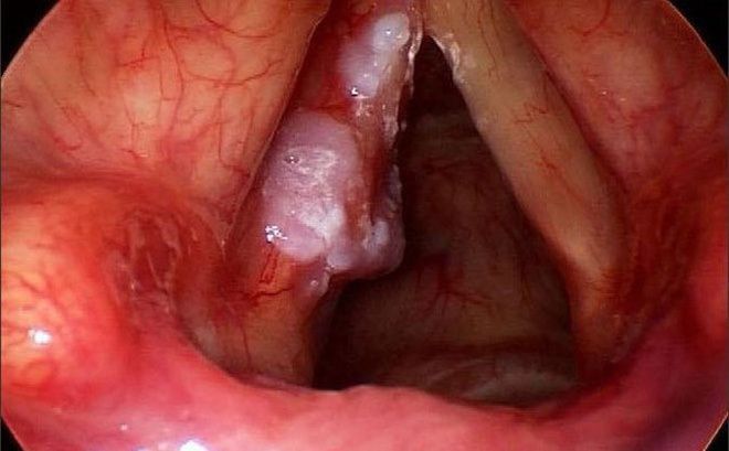 Uống nhiều rượu đặc biệt liên quan đến ung thư trên các dây thanh âm và các khu vực xung quanh các dây thanh