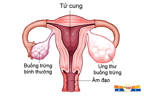 Nguyên nhân và triệu chứng ung thư buồng trứng
