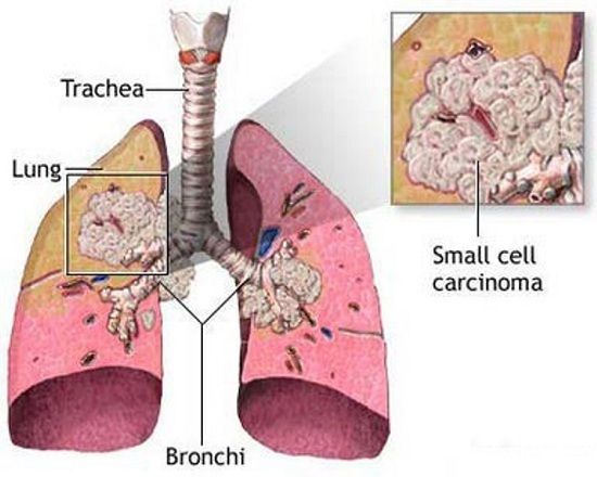 Người có tiền sử mắc bệnh về phổi dễ bị ung thư phổi