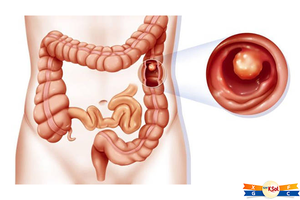Khó thở là 1 trong những dấu hiệu ung thư đại tràng khi di căn