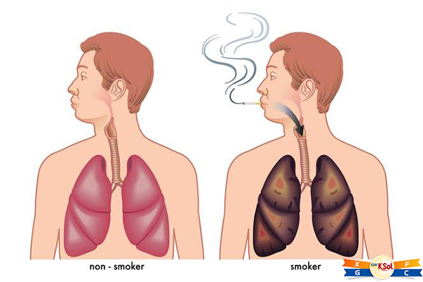 Hút thuốc lá là nguyên nhân hàng đầu gây ra ung thư phổi