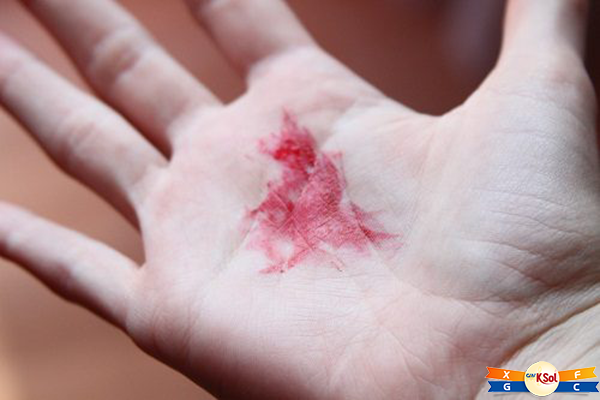 Ung thư thực quản giai đoạn cuối sống được bao lâu?