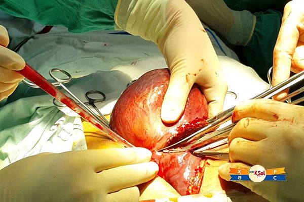 việc phẫu thuật được chỉ định cho các bệnh nhân có chức năng gan ổn định, không tăng huyết áp.