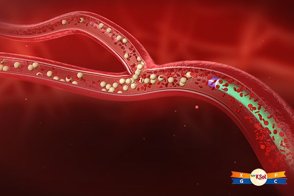 Cận xạ trị là phương pháp đưa nguồn xạ trị vào gần khối u