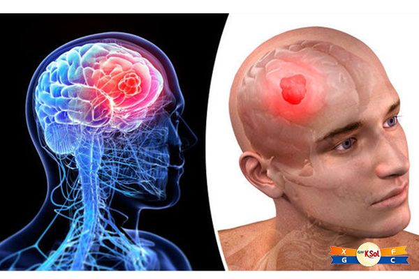 Ung thư não thường được sử dụng phương pháp cận xạ trị