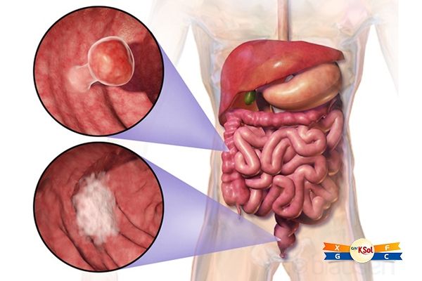 Nếu kiểm tra hậu môn thấy cục nhỏ nổi lên thì là trĩ, còn nếu thấy những cục cứng như hoa cải, thì có thể bạn đã mắc ung thư