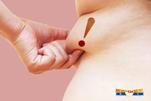 Thừa cân hoặc béo phì có thể làm tăng nguy cơ ung thư dạ dày