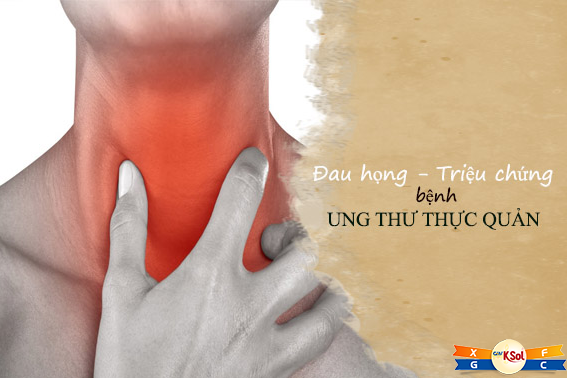 Dấu hiệu dễ thấy của ung thư thực quản