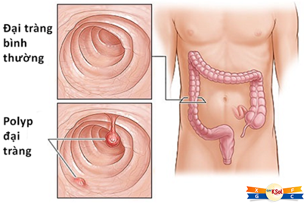 tong-quan-ve-benh-polyp-dai-truc-trang (1)