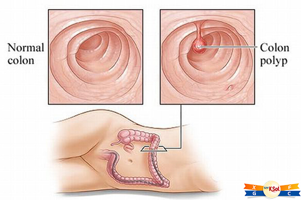 tong-quan-ve-benh-polyp-dai-truc-trang (2)