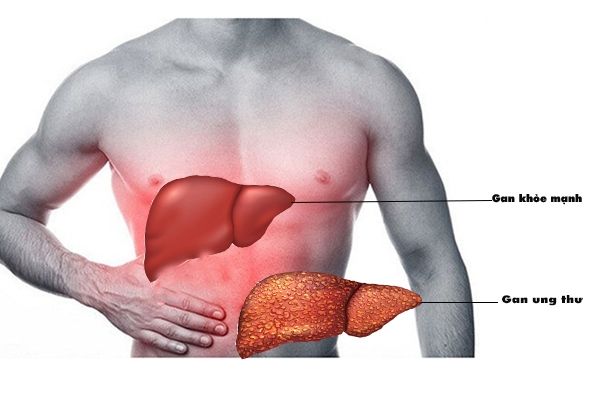 Phần lớn ung thư giai đoạn đầu thường phát triển âm thầm