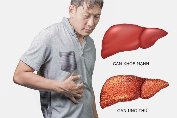 Ung thư gan gây ra nhưng cơn đau dữ dội