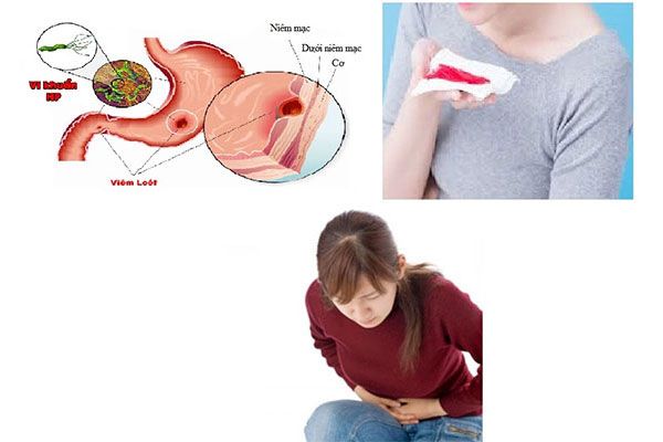 Ung thư dạ dày có chữa được không?