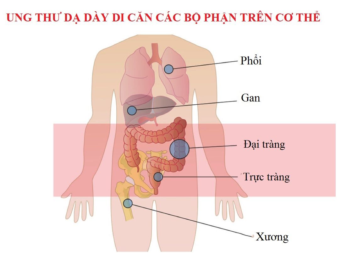 Ung thư da day _ di căn trên cơ the