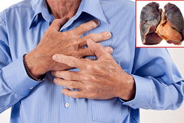 Ung thư phổi gây ra những cơn đau tức ngực