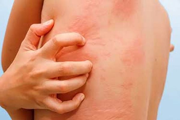 men gan cao lam gây ra ngứa toan thân