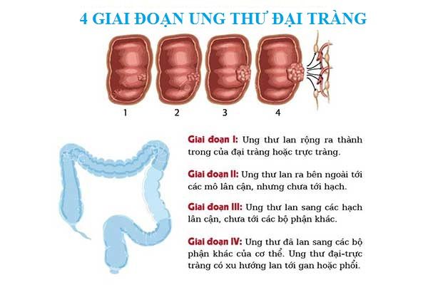 các giai đoạn ung thư đại tràng