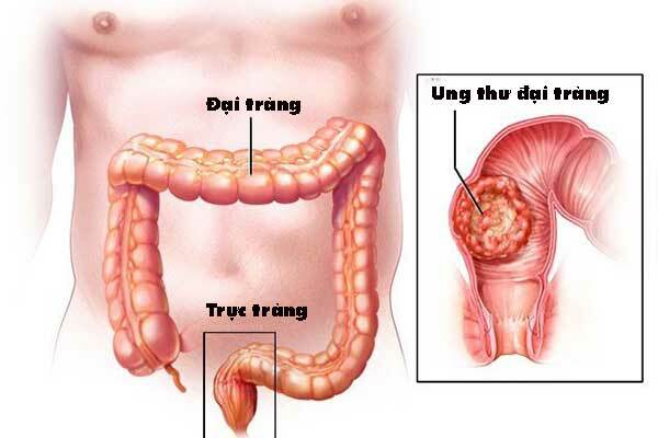 Những dấu hiệu cảnh báo ung thư đại trực tràng sớm nhất