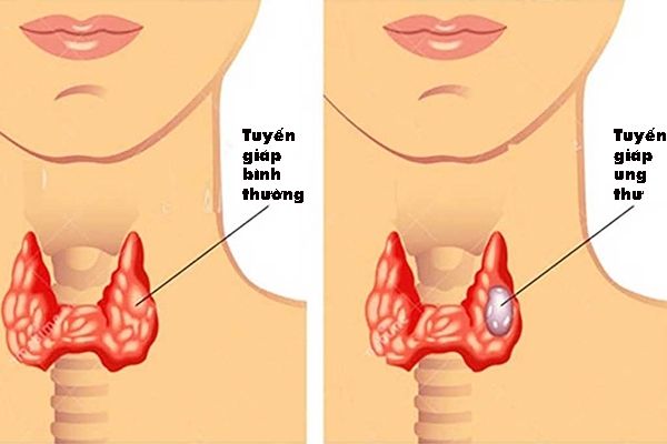 Dấu hiệu ung thư tuyến giáp
