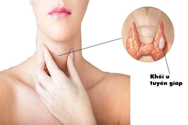 Dấu hiệu nhận biết ung thư tuyến giáp