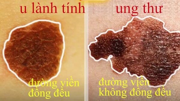 Nhận biết giữa u lành tính và ung thư da qua đường viền không đồng đều