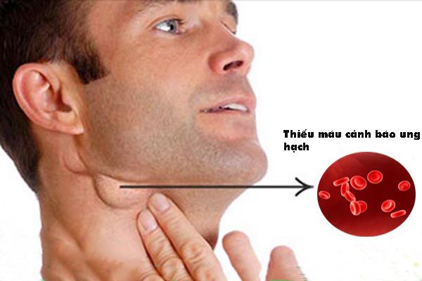 Thiếu máu là một trong những dấu hiệu ung thư hạch
