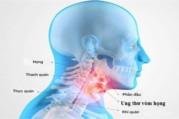 Tỷ lệ nam giới mắc ung thư vòm họng so với nữ giới cao gấp 3 lần