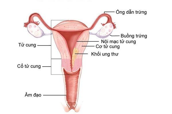 Dấu hiệu nhân biết ung thư nội mạc tử cung