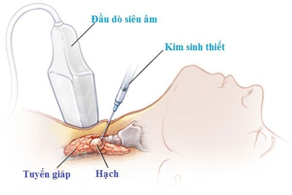 Nhá»¯ng Ä'iá»u Cáº§n Biáº¿t Vá» Ung ThÆ° Tuyáº¿n Giap Thá»ƒ Nhu Khong Thá»ƒ Bá» Qua