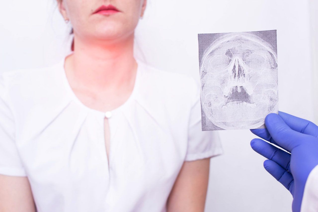Nguyên nhân gây di căn của ung thư vòm họng tới phổi là gì?
