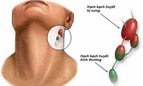 Ung thư hạch bạch huyết có thể chữa được nếu phát hiện bệnh sớm