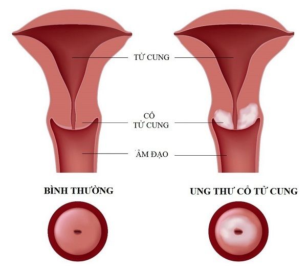 Hình ảnh cổ tử cung bình thường và cổ tử cung bị ung thư