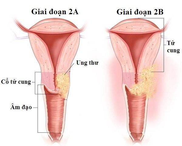 Những kiến thức không nên bỏ qua về ung thư cổ tử cung giai đoạn 2