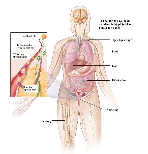 Ung thư cổ tử cung giai đoạn 4B khi ung thư đã di căn tới các bộ phận khác trong cơ thể