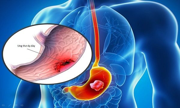 Ung thư dạ dày giai đoạn cuối là một trong những nguyên nhân gây tử vong hàng đầu