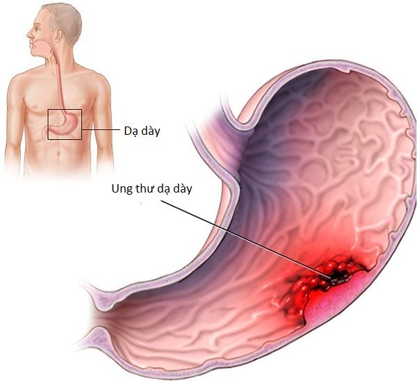 Ung thư dạ dày là loại bệnh nguy hiểm có tần suất mắc mới rất cao