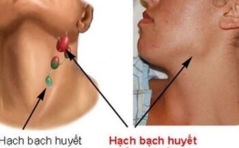 Ung thư hạch bạch huyết giai đoạn cuối có chữa được không?